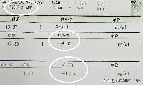 癌胚抗原多少才算癌症？