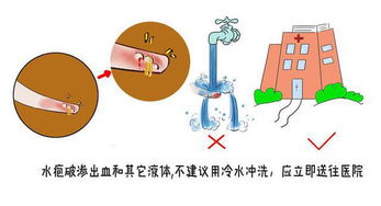 窦骁烫伤后冷静处理，烫伤后的处理步骤是什么？