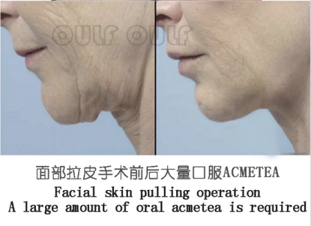 电波拉皮除皱效果好吗