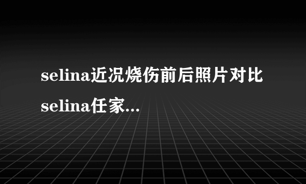 selina近况烧伤前后照片对比 selina任家萱为什么被骂忘恩负义