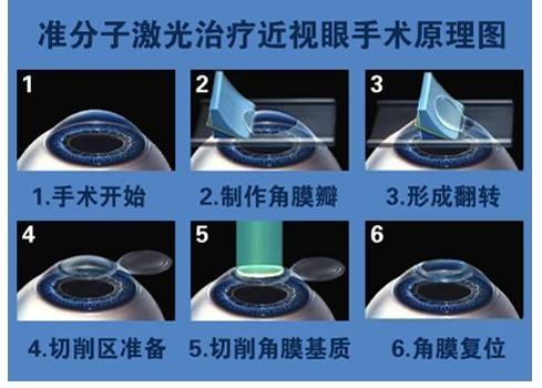 激光打眼有什么危害，国外禁止了？