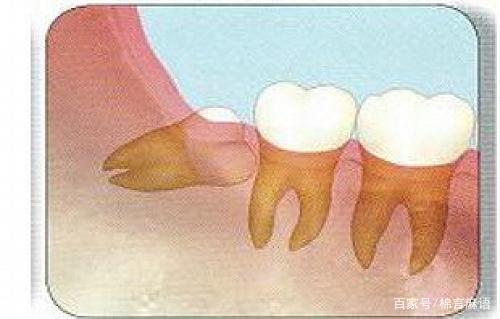 这样的智齿需要拔吗（有图）