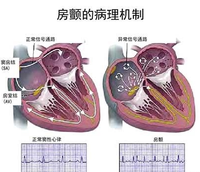 关于房颤手术