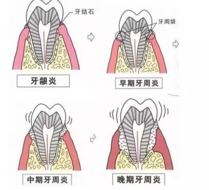 牙齿为什么会痛呢？