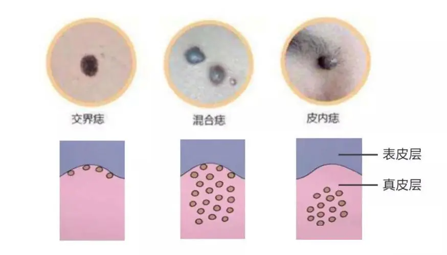 痣是怎么形成的