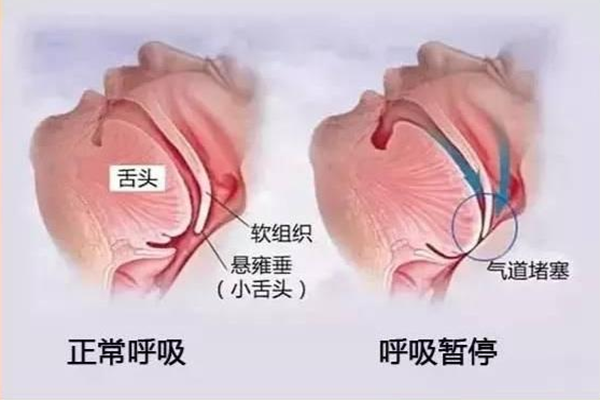 睡眠呼吸暂停综合征的后果?