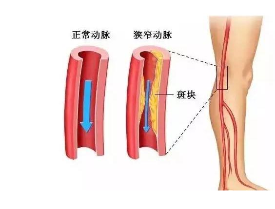 什么是下肢动脉硬化闭塞症？