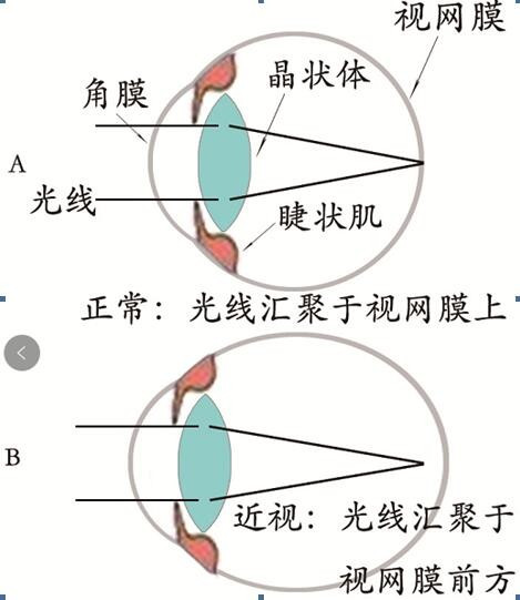 怎样恢复眼睛视力