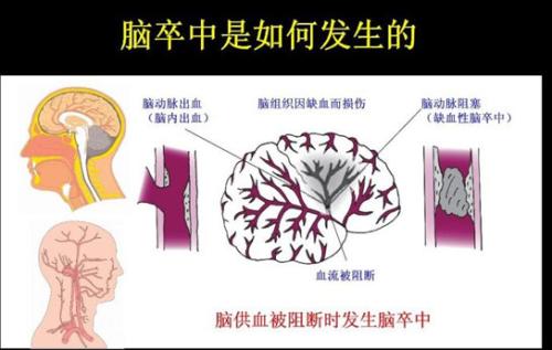 医学中简称CVD是什么