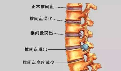 髓核是不是就是骨髓啊