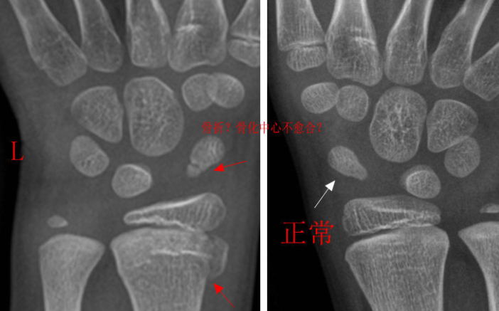 腕部出现8个骨化中心是什么意思