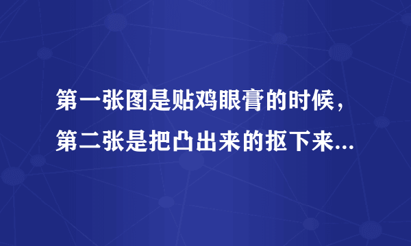 第一张图是贴鸡眼膏的时候，第二张是把凸出来的抠下来了，最后一张是我把白色的都抠掉以后的，请问这是好